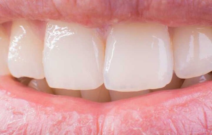 Use These Common Items in Your Pantry to Whiten Your Teeth