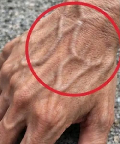 Understanding Prominent Veins in the Hands